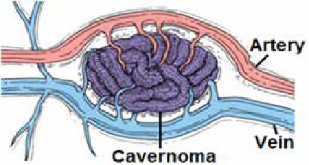 CAVERNOMA CEREBRAL | Héctor Alvarez Faedo